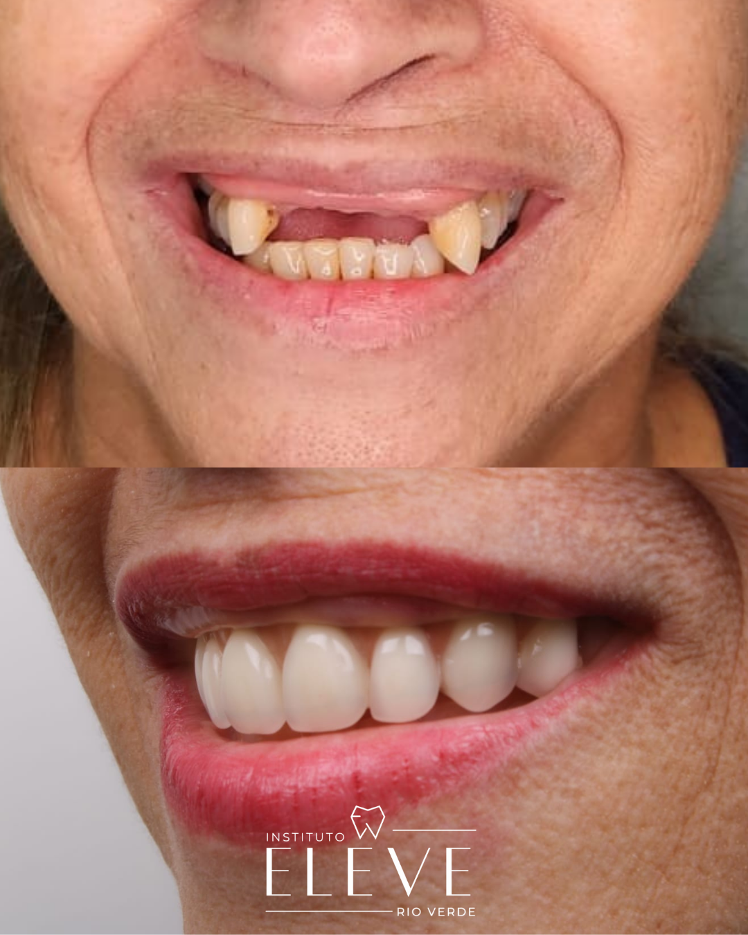 Implantes - Facetas e lentes dental - proteses - Clareamento (1)