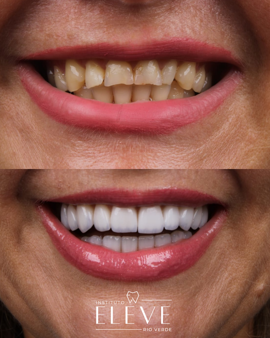 Implantes - Facetas e lentes dental - proteses - Clareamento (2)