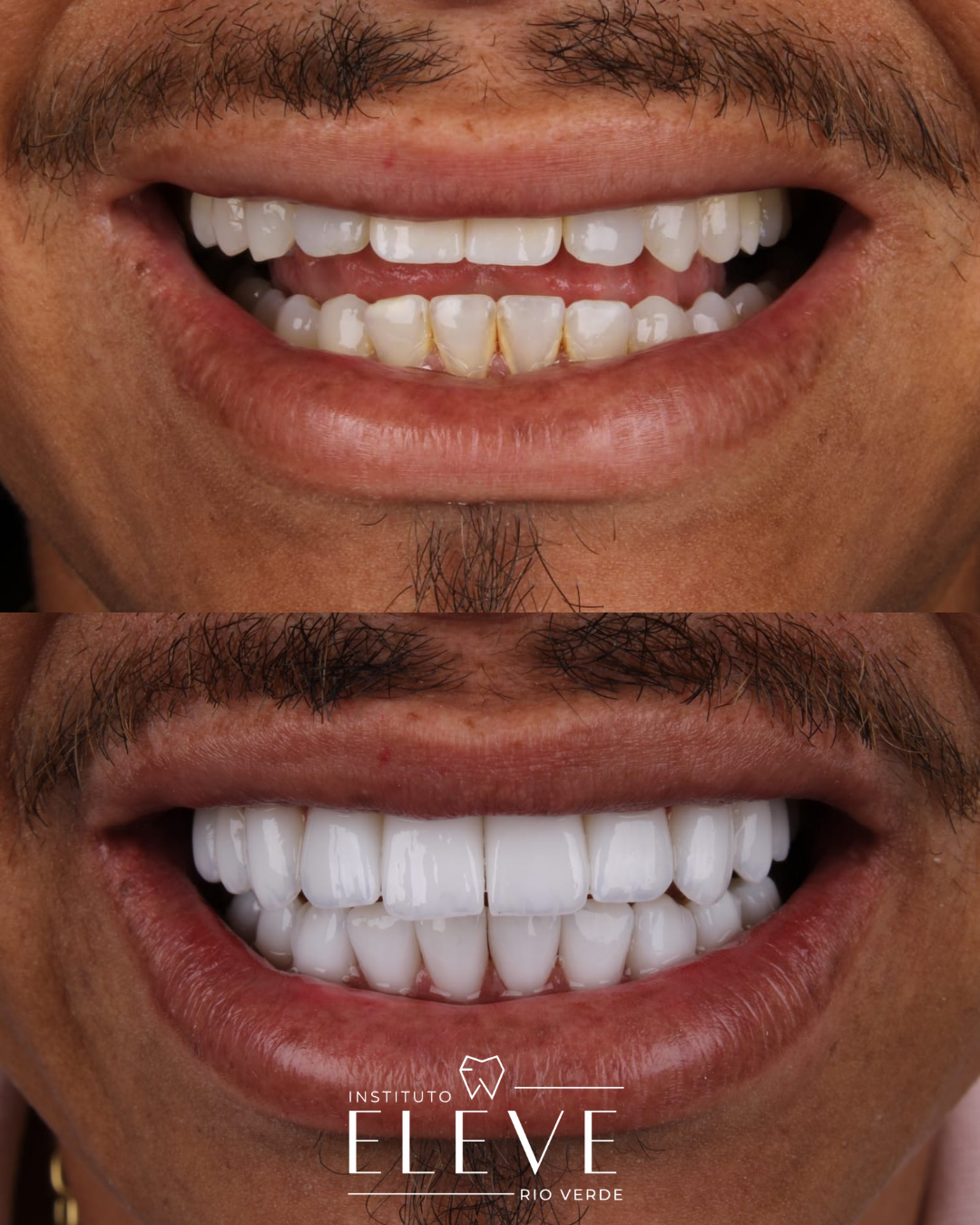 Implantes - Facetas e lentes dental - proteses - Clareamento (3)