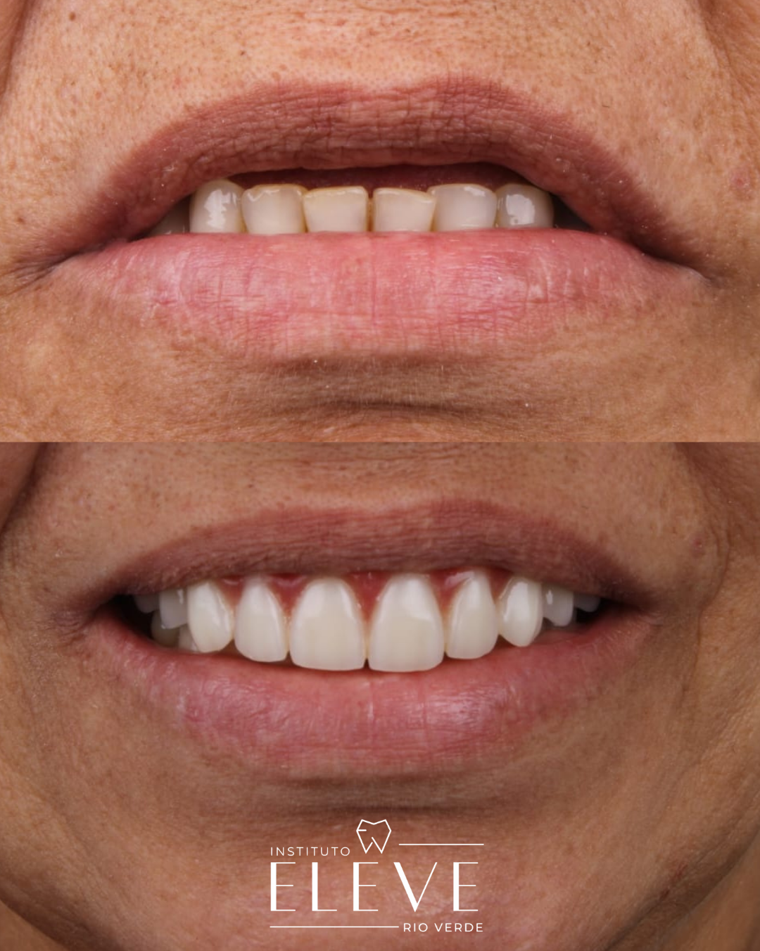 Implantes - Facetas e lentes dental - proteses - Clareamento (4)