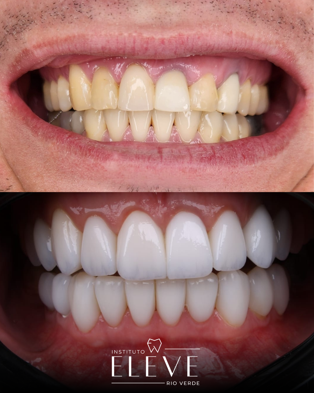 Implantes - Facetas e lentes dental - proteses - Clareamento (5)