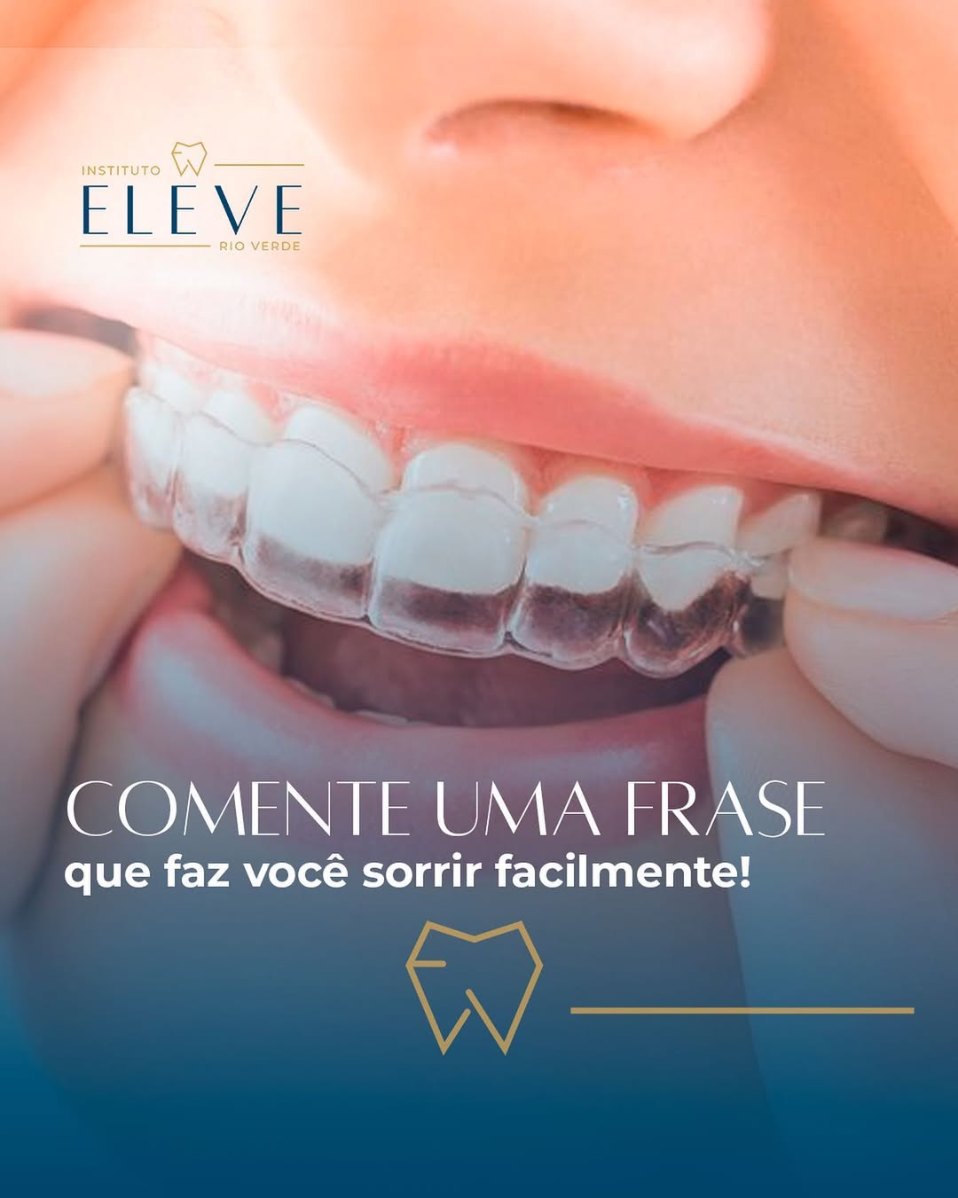 invisaling - aparelho ortodontico - aparelho dental 2