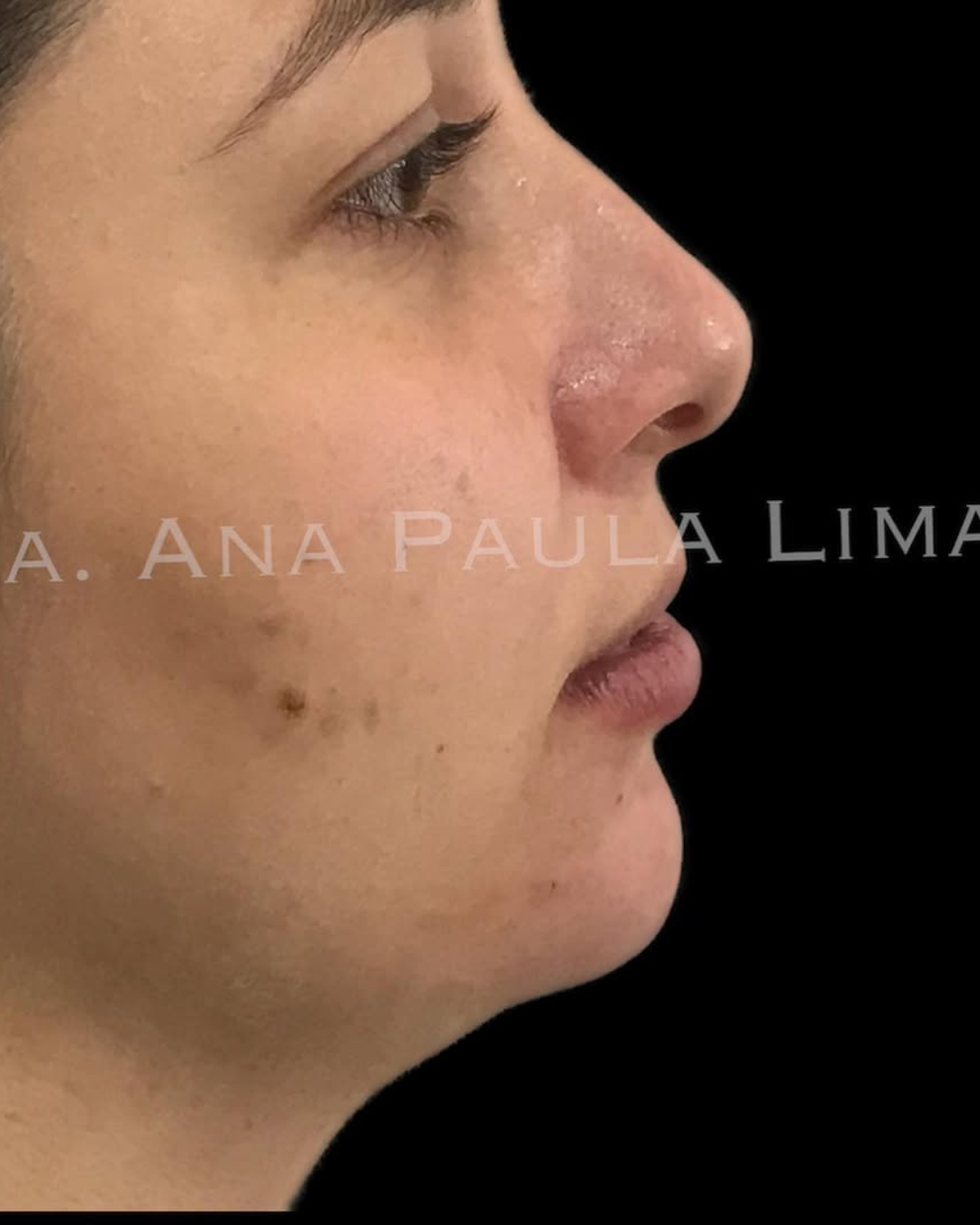 paciente harmonização orofacial 01 (1)