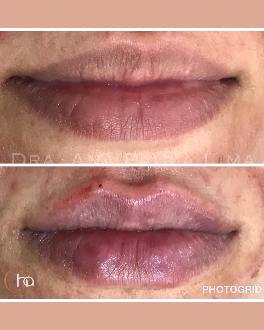 paciente harmonização orofacial 01 (11)