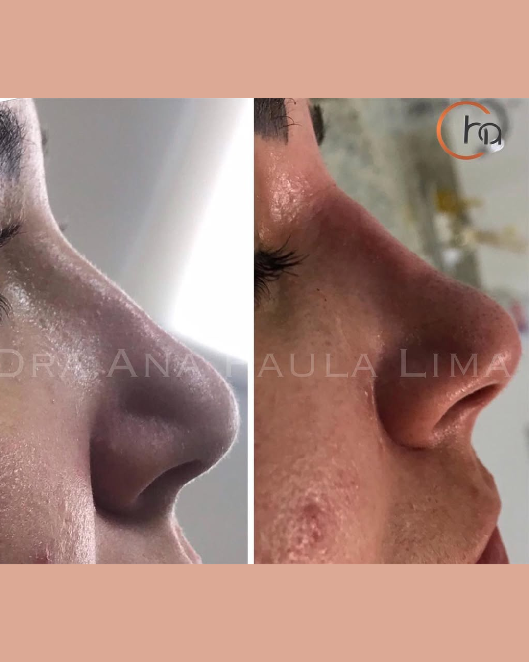 paciente harmonização orofacial 01 (12)