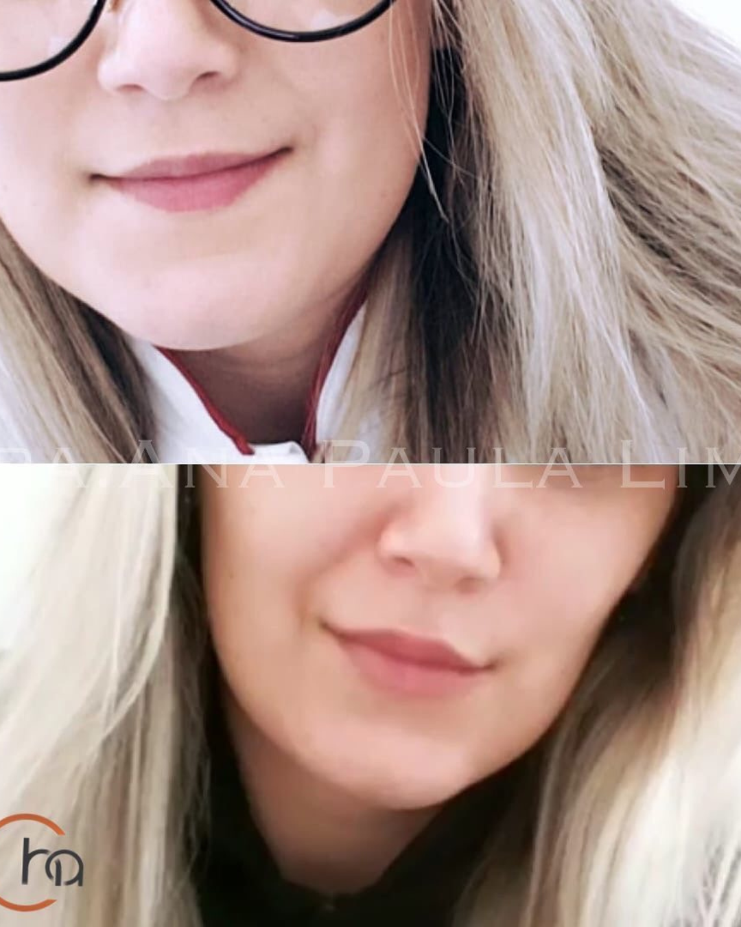 paciente harmonização orofacial 01 (13)