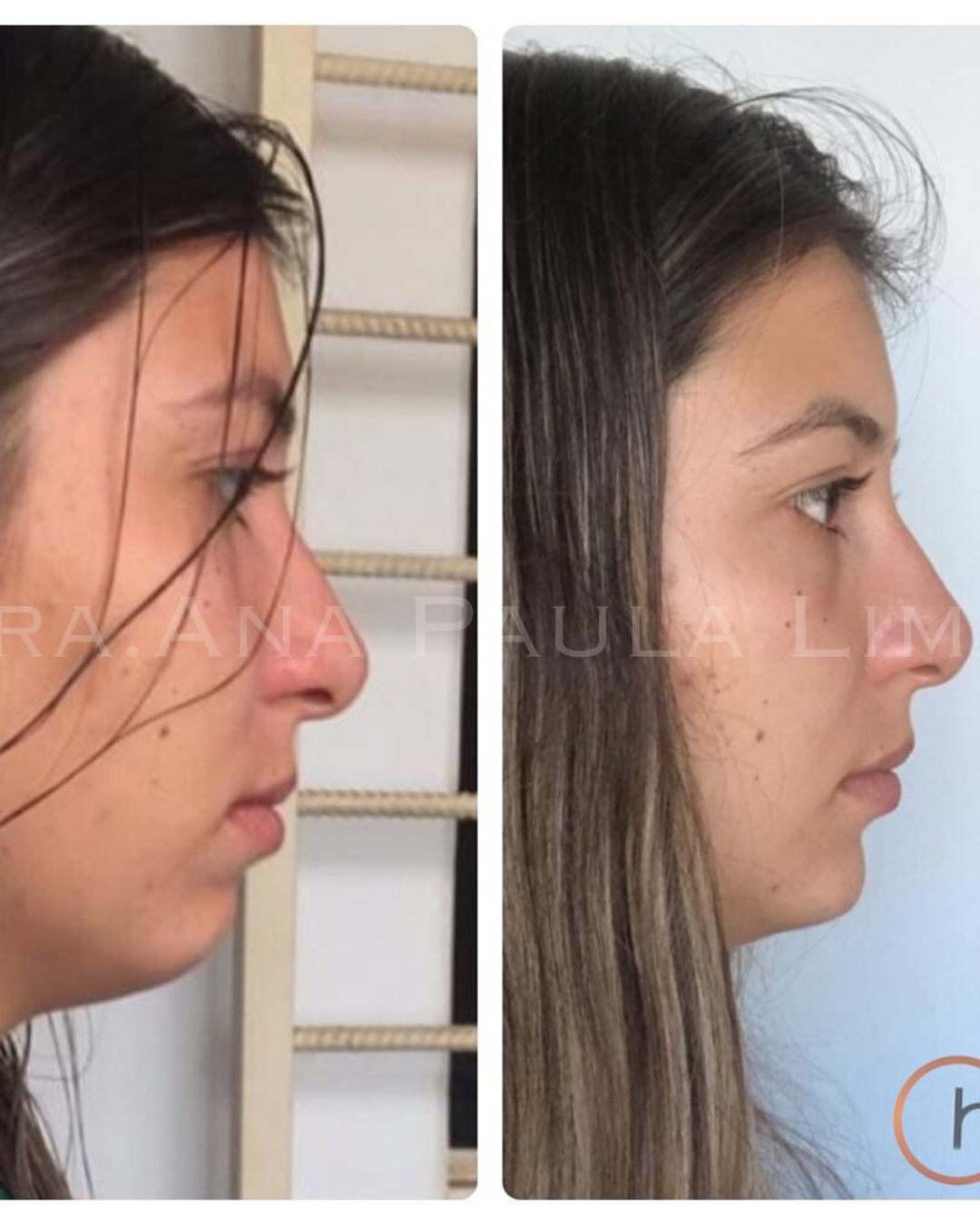 paciente harmonização orofacial 01 (14)