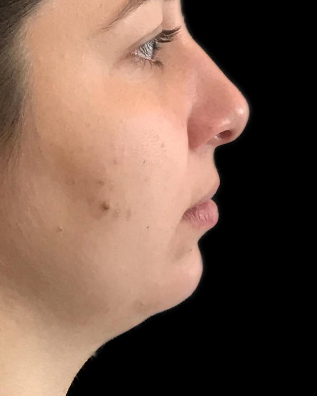 paciente harmonização orofacial 01 (2)