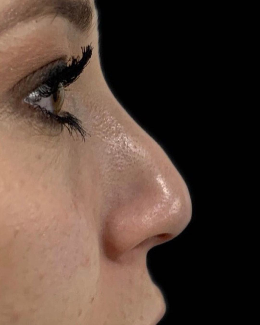 paciente harmonização orofacial 01 (4)