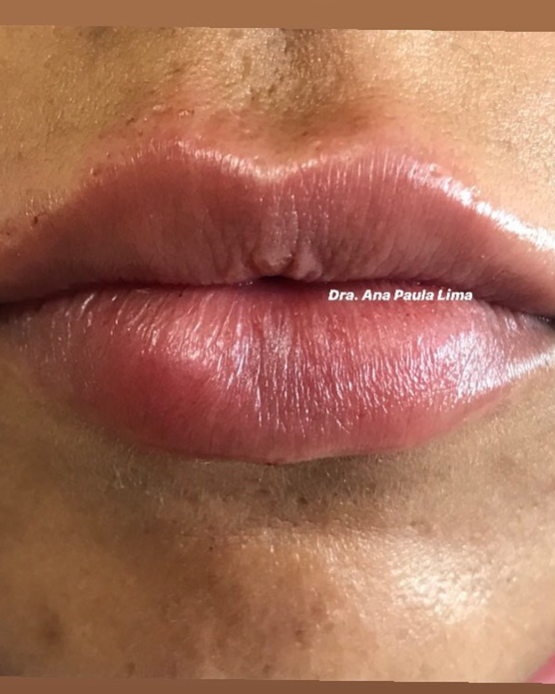 paciente harmonização orofacial 01 (5)