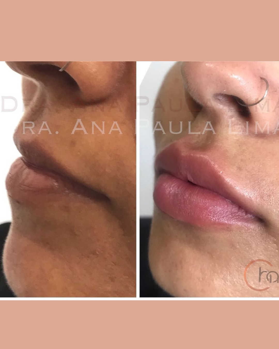 paciente harmonização orofacial 01 (6)