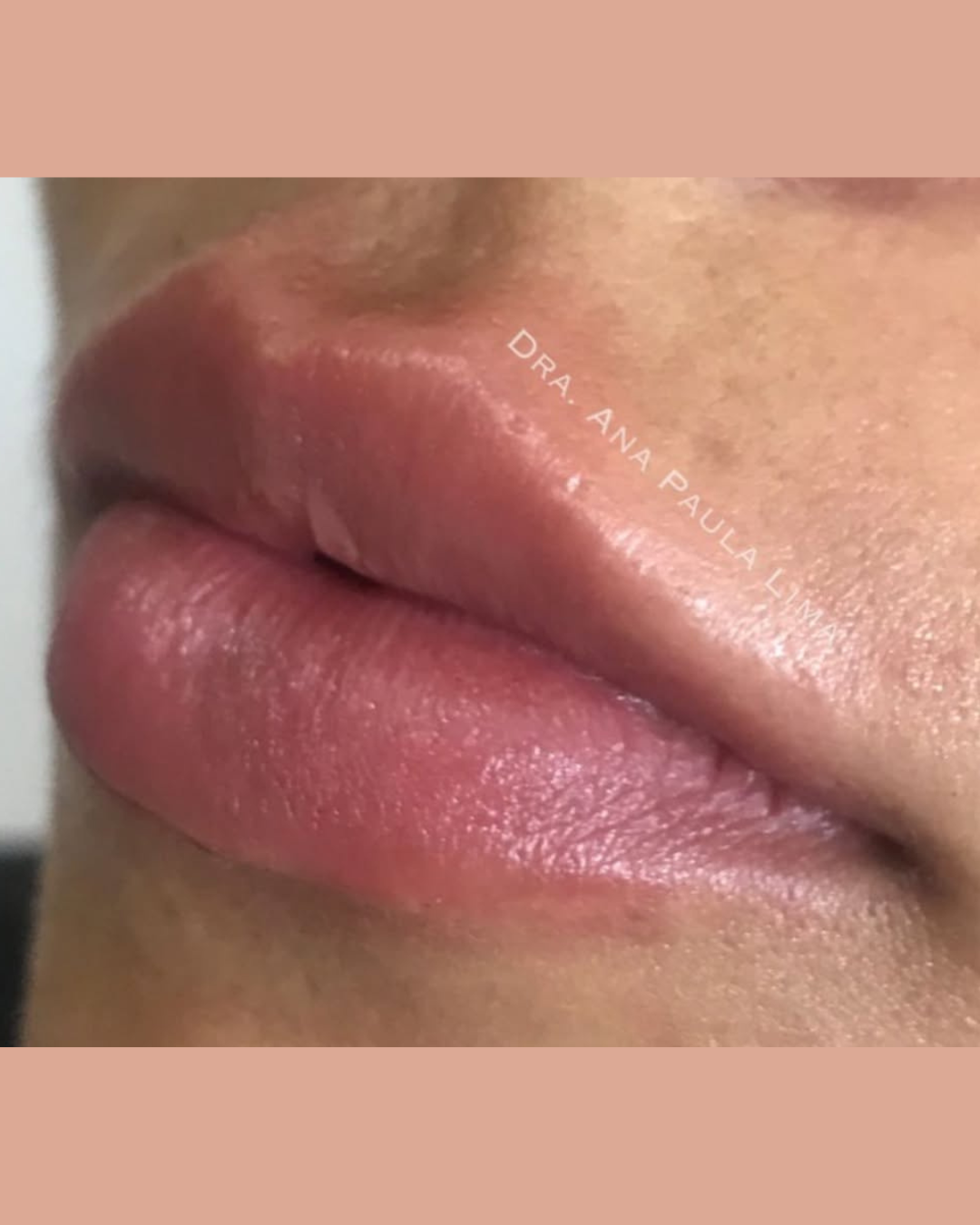 paciente harmonização orofacial 01 (7)