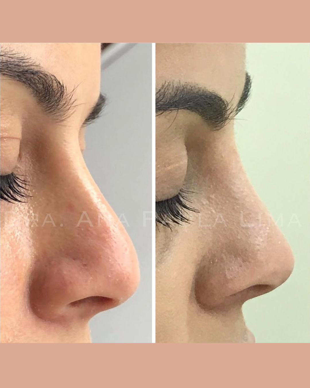 paciente harmonização orofacial 01 (8)