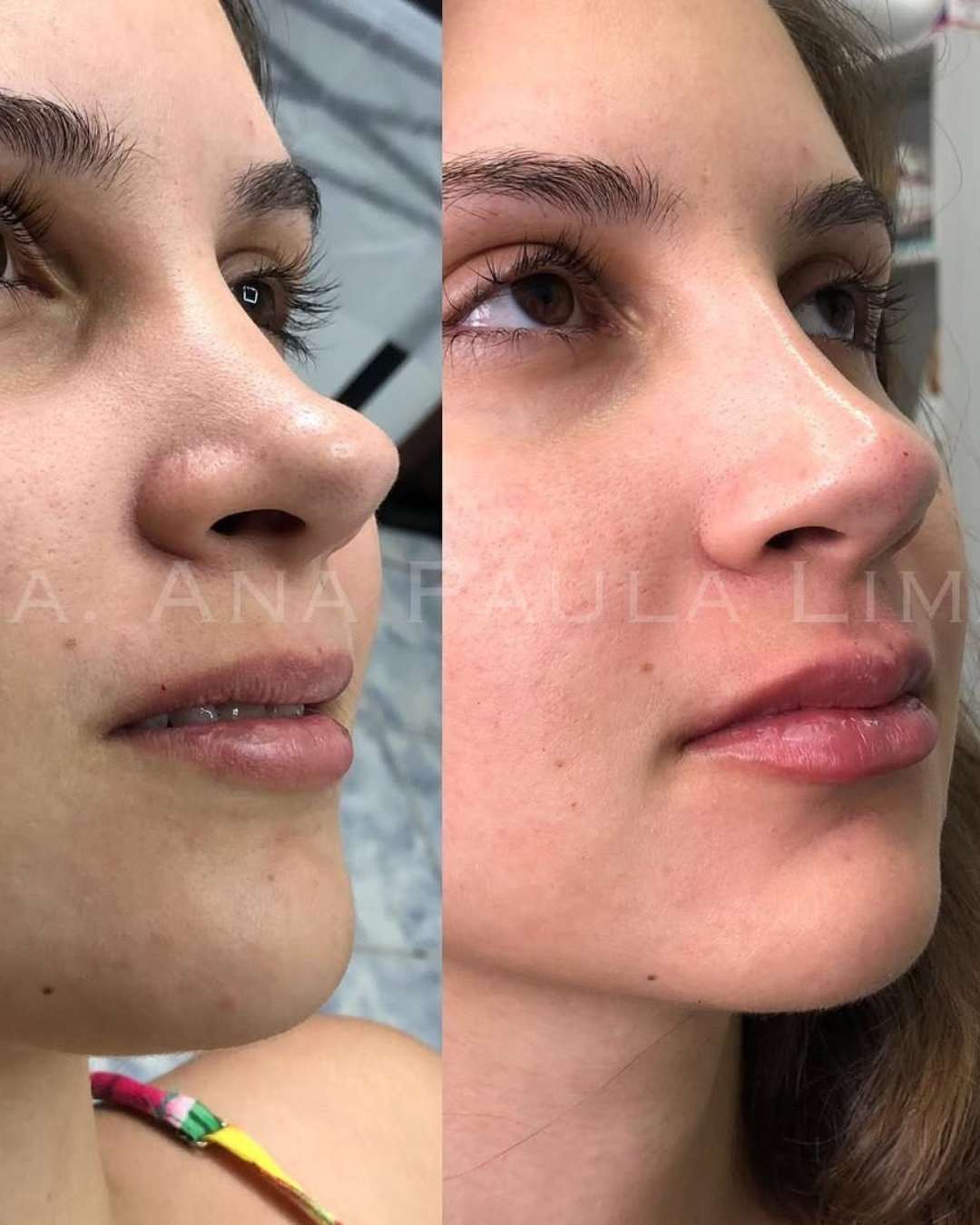 paciente harmonização orofacial 01 (9)